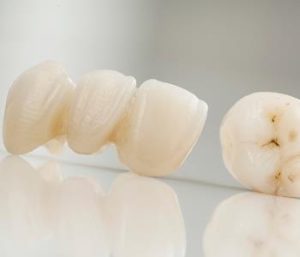 Glen Allen area dentist explains dental bridge options