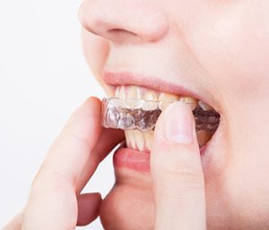 Dr oliviya heart, Virginia Biological Dentistry Proving Dental Clear Braces