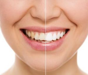 Blog 11 Home teeth whitening solutions from expert dentist in Glen Allen