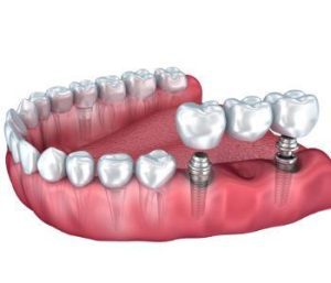 Blog 7 missing teeth solutions dental implants from dentist in richmond, va