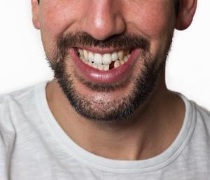 missing tooth replacement using dental crowns from Virginia Biological Dentistry