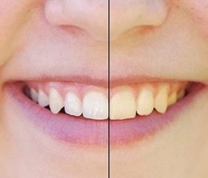Blog 10 effective teeth whitening solutions from expert dentist in Fredericksburg, VA