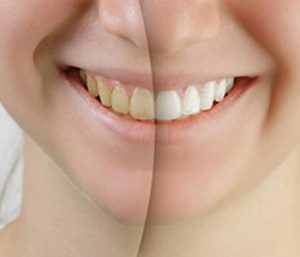 Blog 12 cost effective teeth whitening procedures from expert dentist in Glen Allen