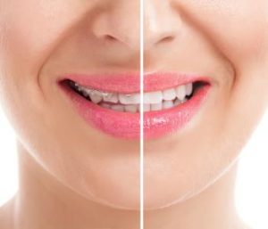 wide variety of professional teeth whitening procedures from dentist in Glen Allen