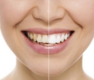 Dr oliviya heart, Virginia Biological Dentistry Proving Teeth Whitening in Glen Allen
