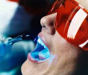 Blog 24 Dr. Hart uses a hard tissue laser to gently remove areas of decay, without drilling