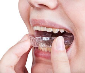 How Occlusal Guards Help With Teeth Grinding in Glen Allen, VA area