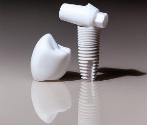 Blog 3 Ceramic Implant Dentist in Glen Allen VA Area