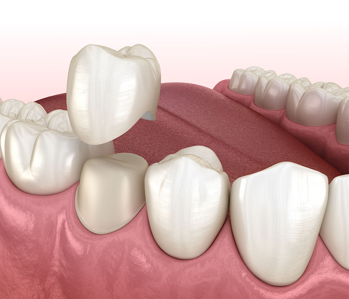Why It Is Important to Repair a Chipped Tooth - Sandston Comprehensive  Dentistry Sandston Virginia