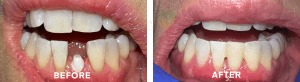 Reasons Why Metal-Free Options Like Ceramic Dental Implants Are Popular Among Biological Dentists 1 zirconia implants bna 1