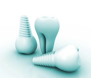 Titanium vs Ceramic Dental Implants in Glen Allen VA Area
