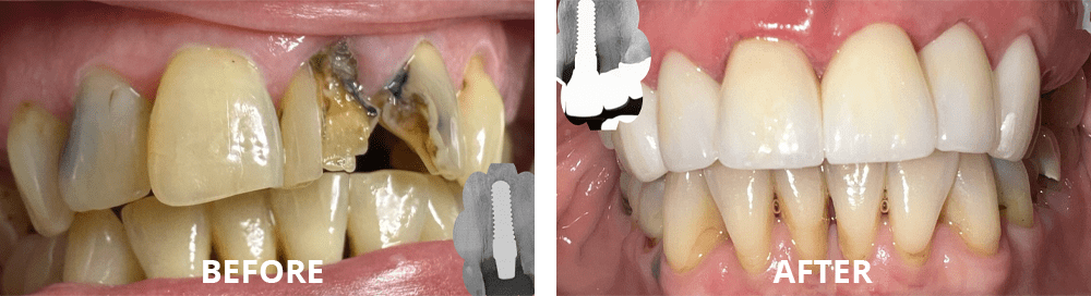 Experience Convenient Dental Care: Your Guide to CEREC Same-day Ceramic Crowns at Virginia Biological Dentistry 1 ceramic implants and ceramic crown restorations bna 1 t1 1