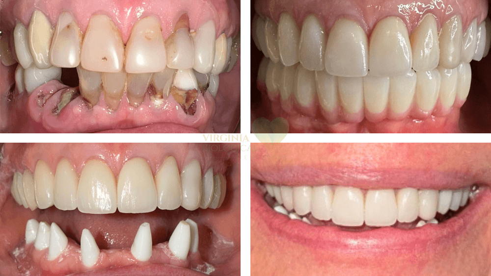 All on 6 Ceramic Implants Before & After Results Case-1