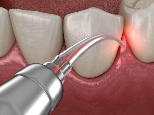 laser treatment
