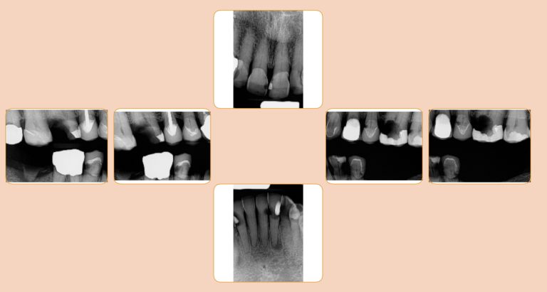 Cavities and Infections and broken teeth