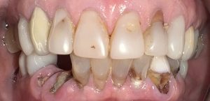 decay infection teeth 1