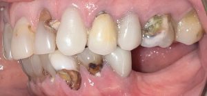 decay infection teeth 2