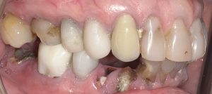 decay infection teeth 3