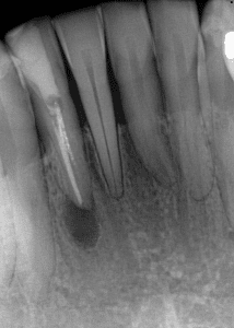 infected root canal