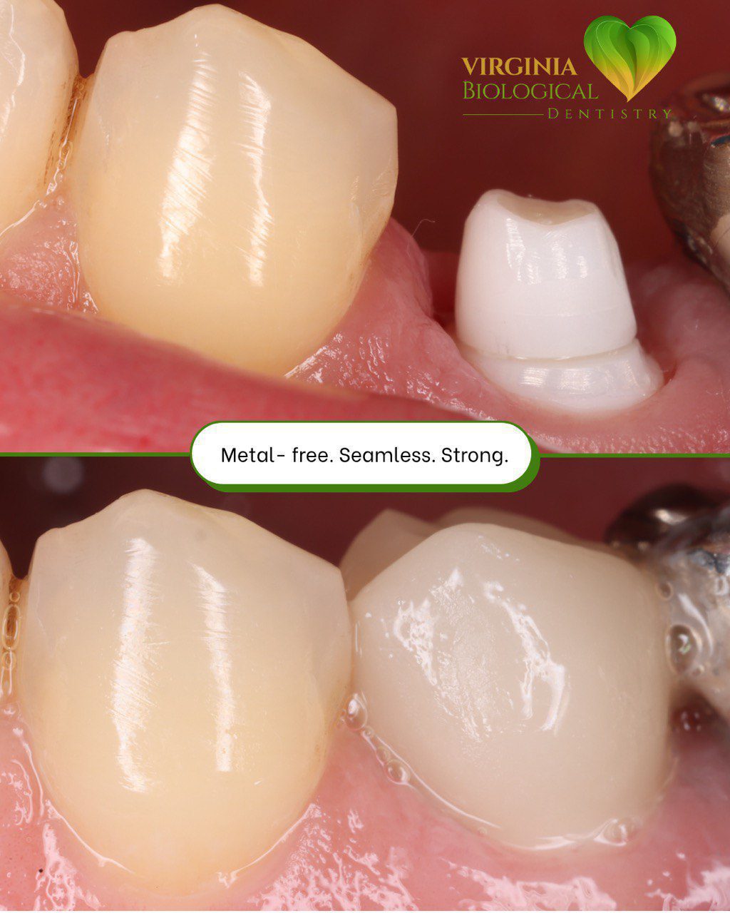 SDS Ceramic Implant Live Surgery & Hands-On Training Course - October 2026 - Virginia Biological Dentistry 5 Metal-free ceramic implant — seamless, strong