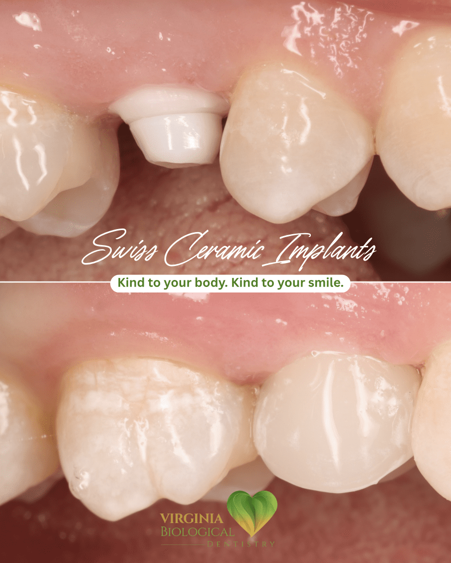 SDS Ceramic Implant Live Surgery & Hands-On Training Course - October 2026 - Virginia Biological Dentistry 4 Swiss Ceramic Implants case — kind to your body, kind to your smile