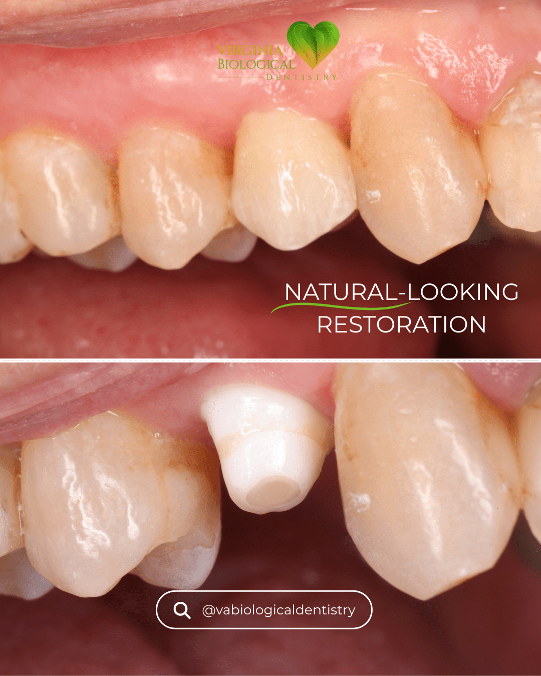SDS Ceramic Implant Live Surgery & Hands-On Training Course - October 2026 - Virginia Biological Dentistry 6 Natural-looking ceramic restoration